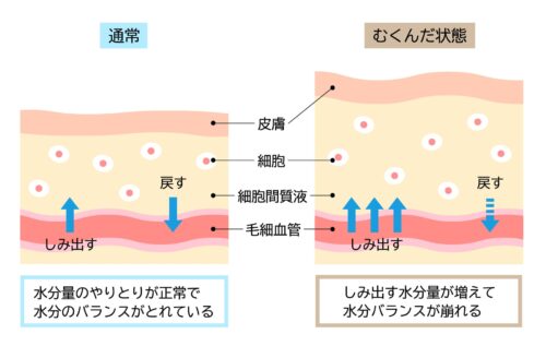 むくみの鍼灸・写真1|鎌ケ谷・松戸・船橋