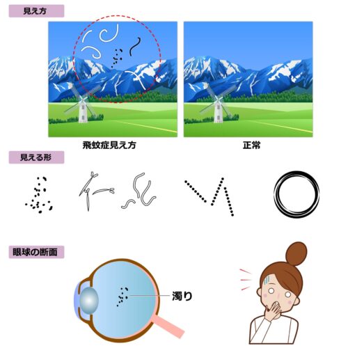 飛蚊症の鍼灸・写真1｜鎌ケ谷・船橋・松戸