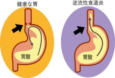 逆流性食道炎の鍼灸・写真1｜鎌ケ谷・松戸・船橋