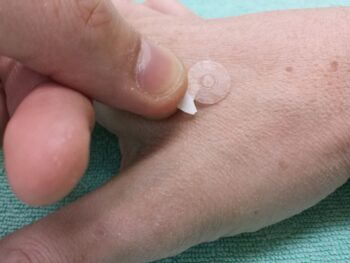 円皮鍼の使い方・写真4