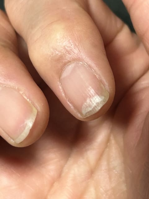 爪割れに効くツボ・写真1