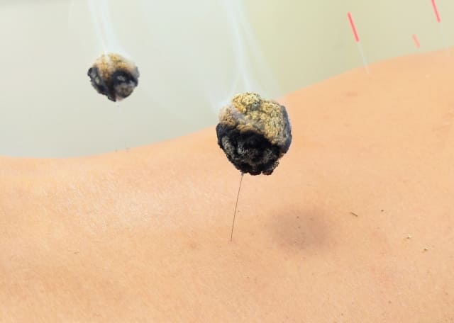 お灸の使い分け・写真6