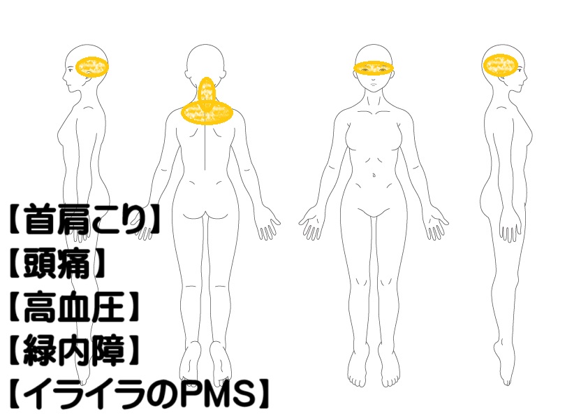 肩こり・高血圧への鍼灸症例・写真1