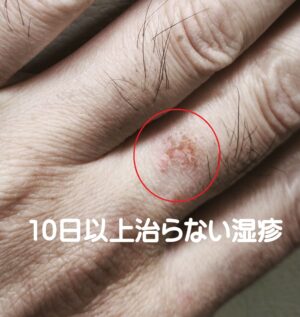 指の湿疹にお灸・写真1