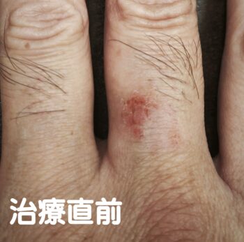指の湿疹にお灸・写真2
