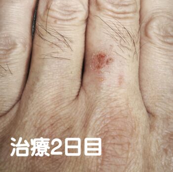 指の湿疹にお灸・写真3
