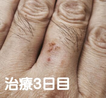 指の湿疹にお灸・写真3