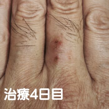 指の湿疹にお灸・写真4