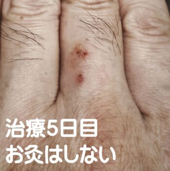 指の湿疹にお灸・写真5