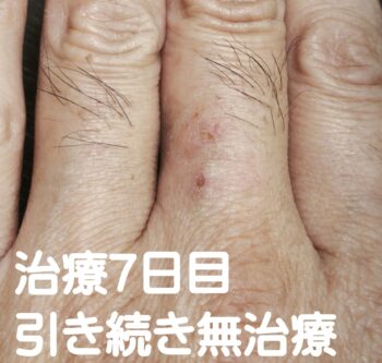 指の湿疹にお灸・写真6