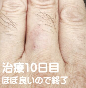 指の湿疹にお灸・写真7