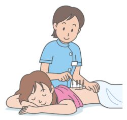 鍼灸施術・イラスト