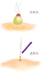 お灸イラスト