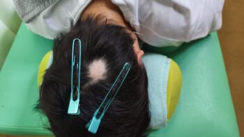 円形脱毛症の鍼灸・写真1