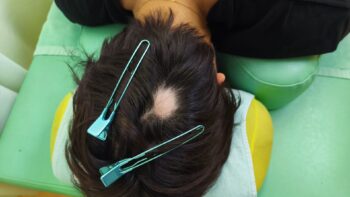 円形脱毛症の鍼灸・写真2