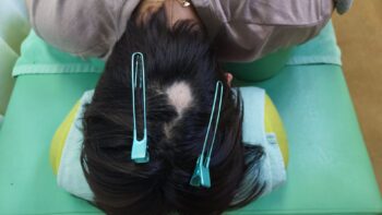 円形脱毛症の鍼灸・写真3