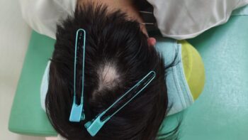 円形脱毛症の鍼灸・写真4