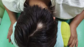 円形脱毛症の鍼灸・写真5