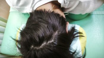 円形脱毛症の鍼灸・写真6