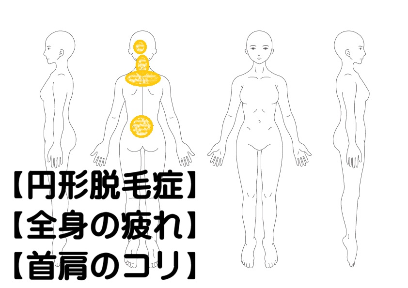 円形脱毛症への鍼灸症例・写真1