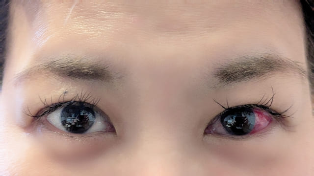 目の充血に効くツボ・写真1