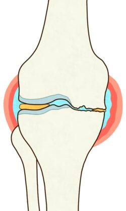 変形性膝関節症にお灸_論文_写真2